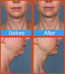 Kybella before and after ft lauderdale